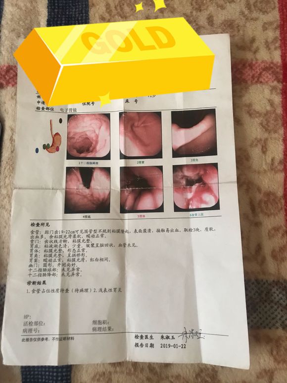 姥姥今年72岁、查出食道癌、现在对于家人来说都不知道怎么办了