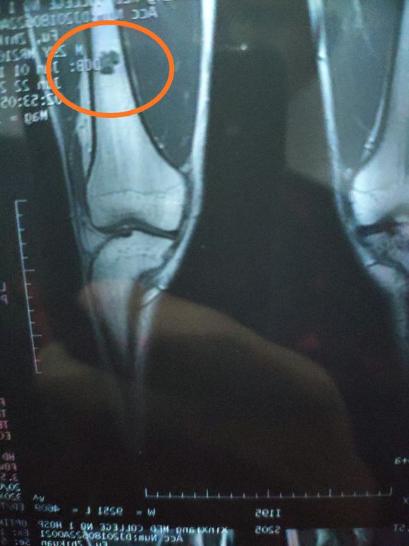 大家看看我的情况需要治疗吗？1图是软骨瘤2图是囊肿