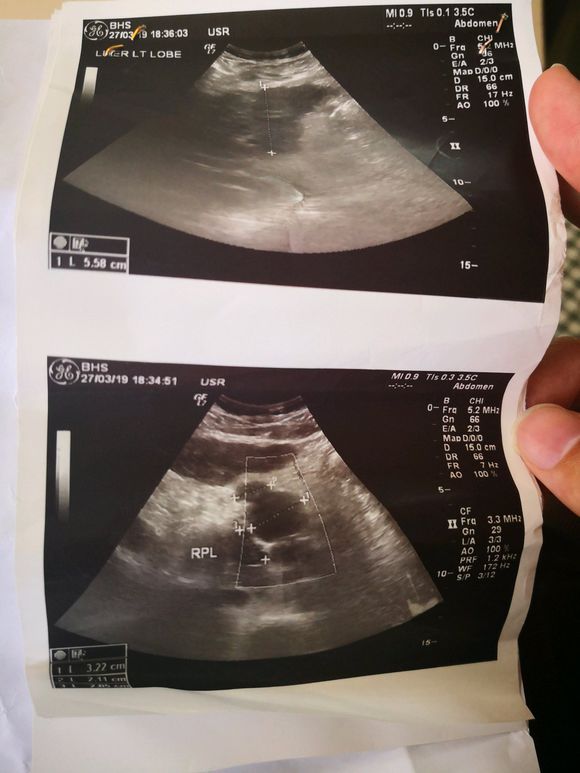 昨天查出肝癌。这么办接下来的路这么走？