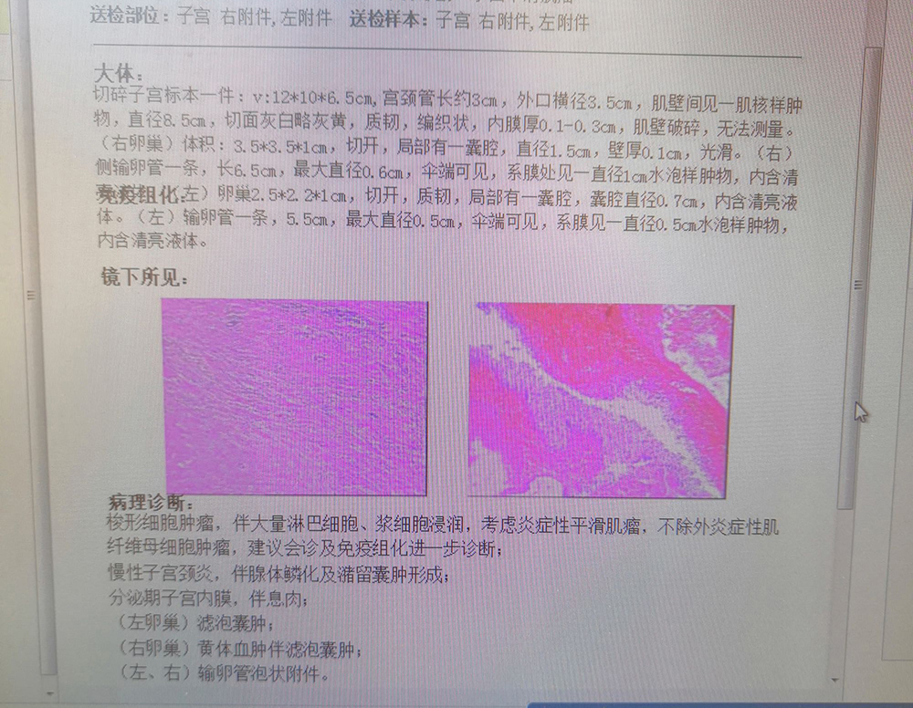 以子宫肌瘤住院。手术切除的子宫、输卵管、卵巢，术后病理