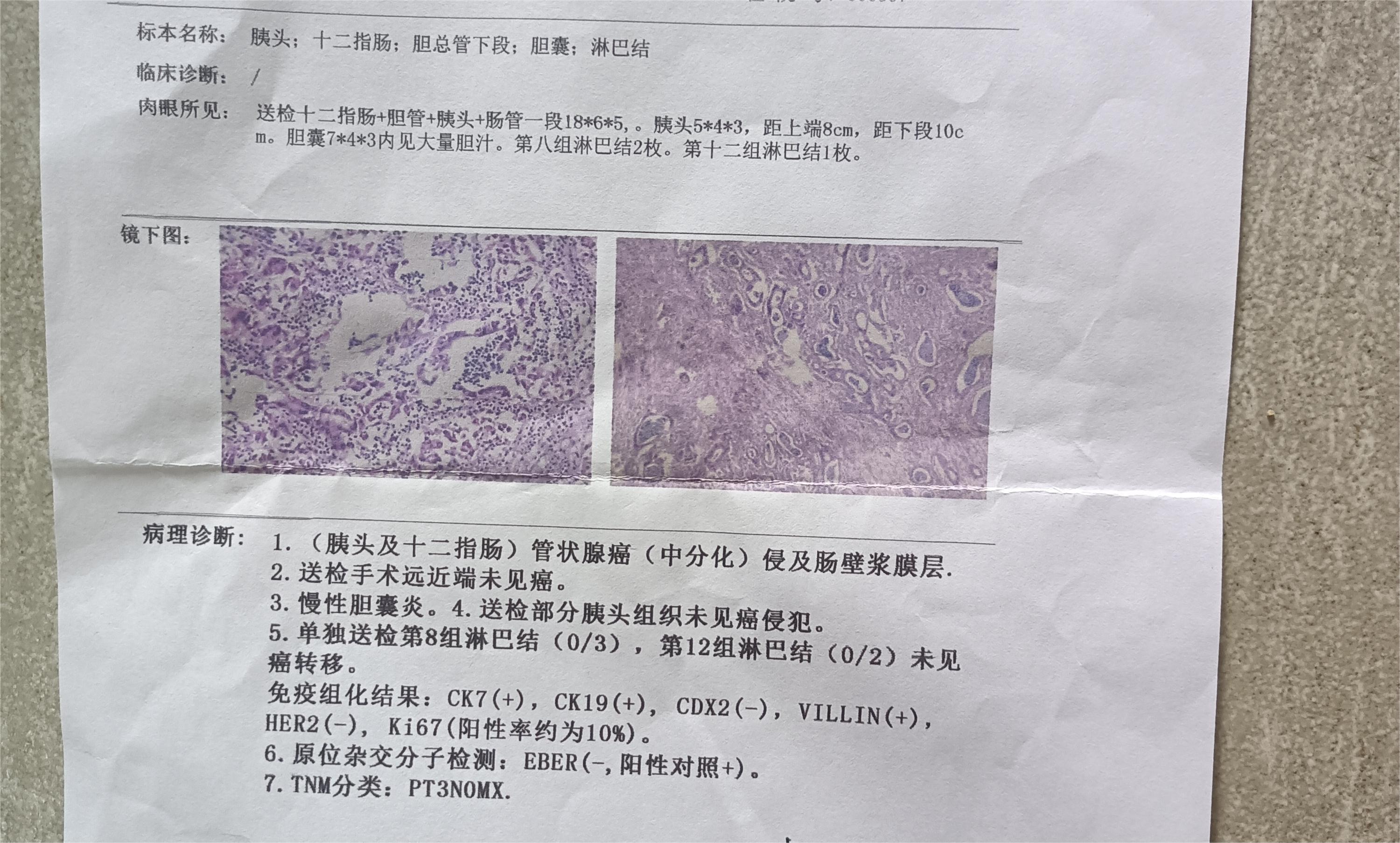 今天病理报告出来了，医生说后期要治疗方案是化疗